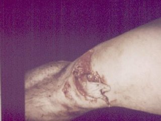 LESION (22)  IMAGENES FOTOS